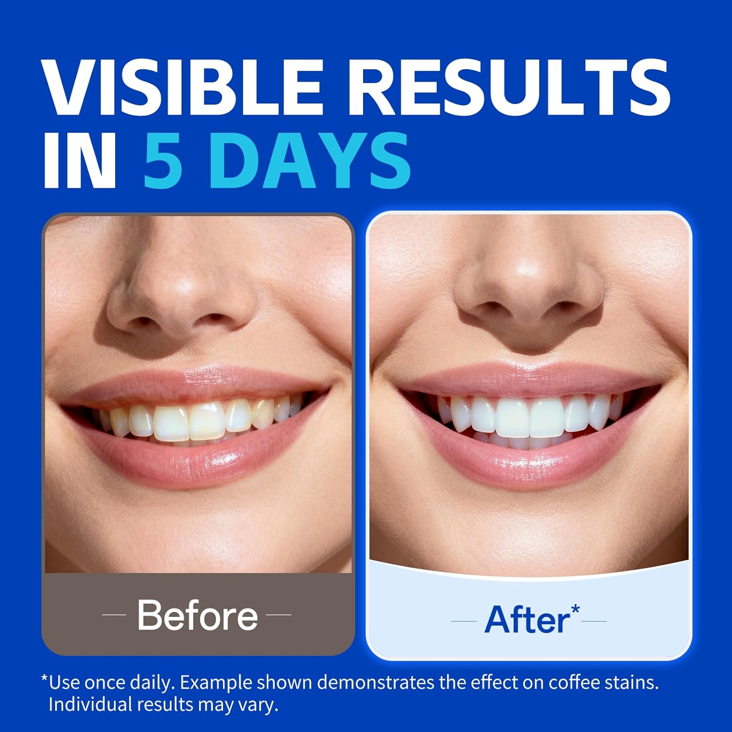 7 пар полосок для отбеливания  – обзор и цена Teeth Whitening Retainer