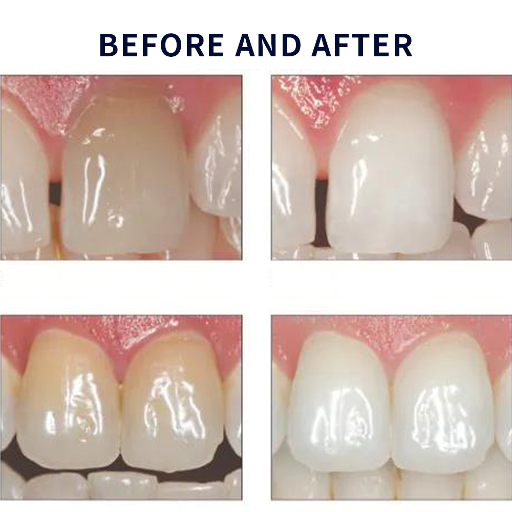 Отбеливающий набор opalution 2 – обзор и цена Teeth Whitening Gel