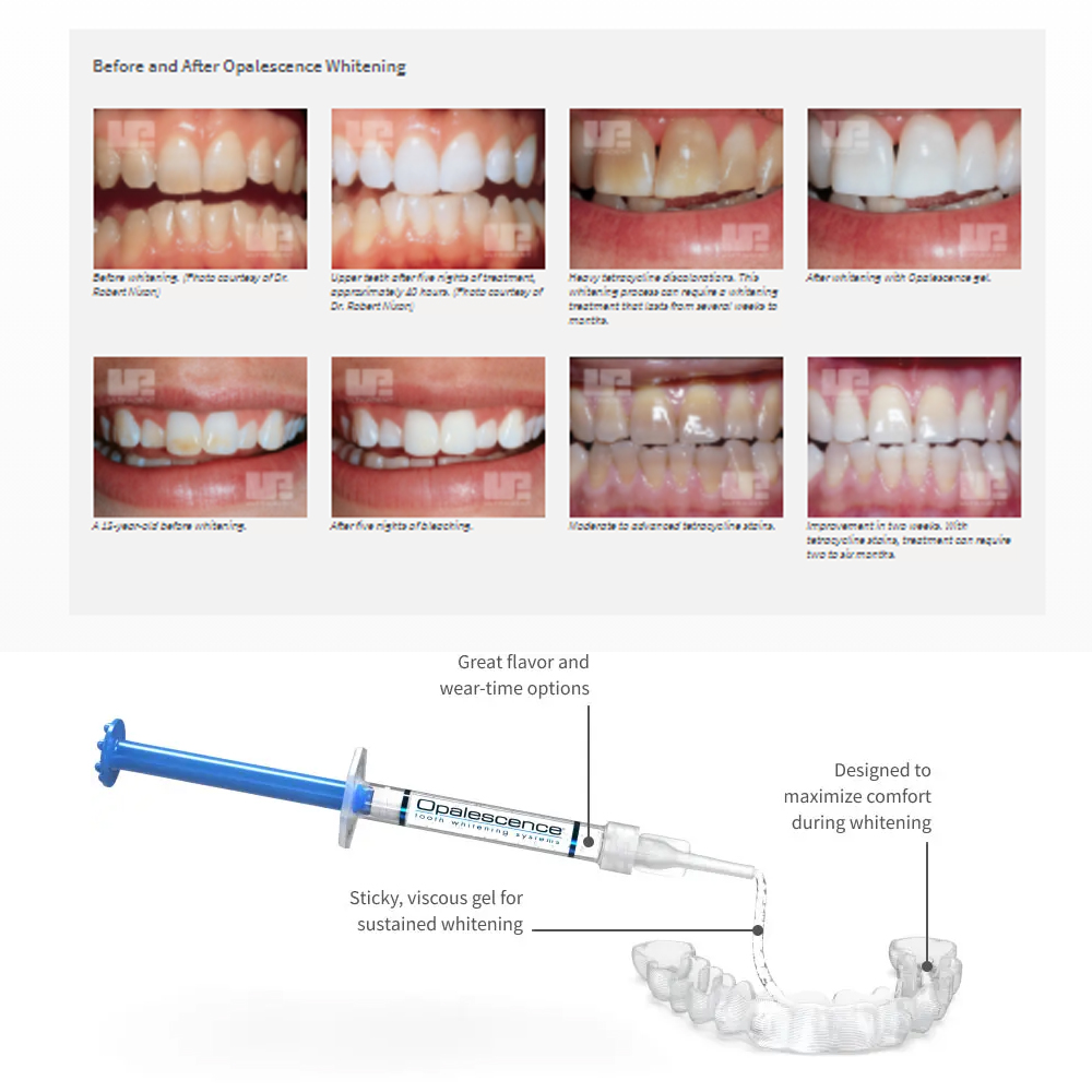 Отбеливающий набор opalution 2 – обзор и цена Teeth Whitening Gel