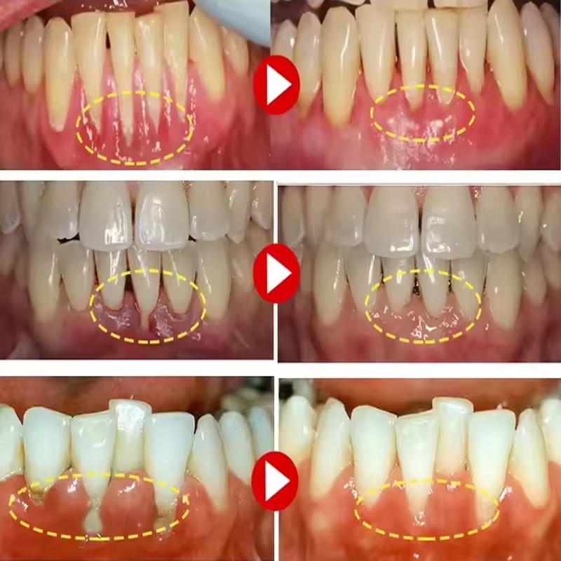 Гель для отбеливания зубов и в – обзор и цена Teeth Whitening Gel
