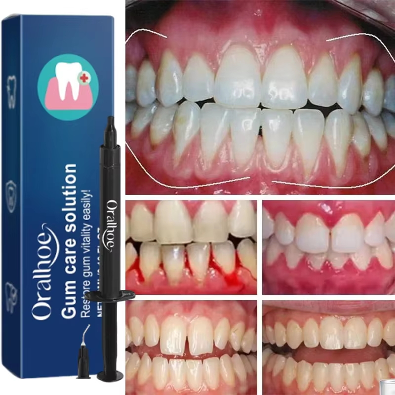 Гель для отбеливания зубов и в – обзор и цена Teeth Whitening Gel