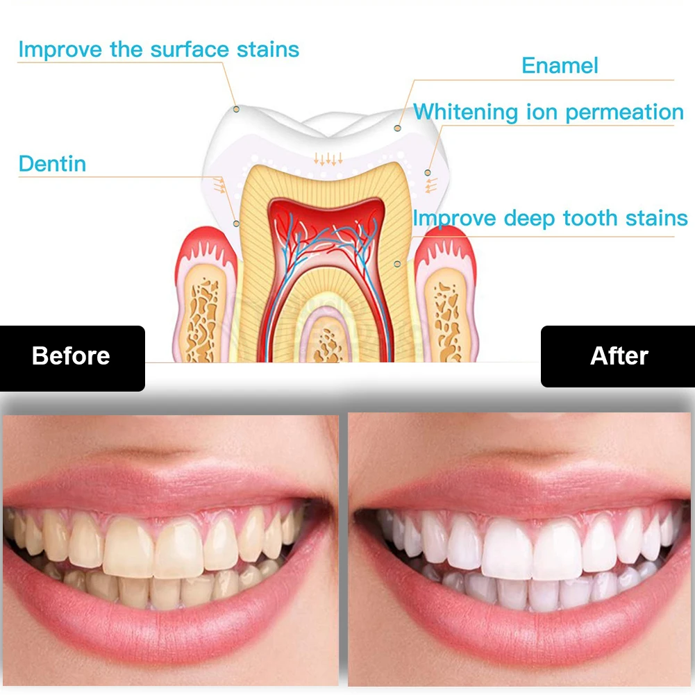 Набор для отбеливания зубов, м – обзор и цена Teeth Whitening With Trays
