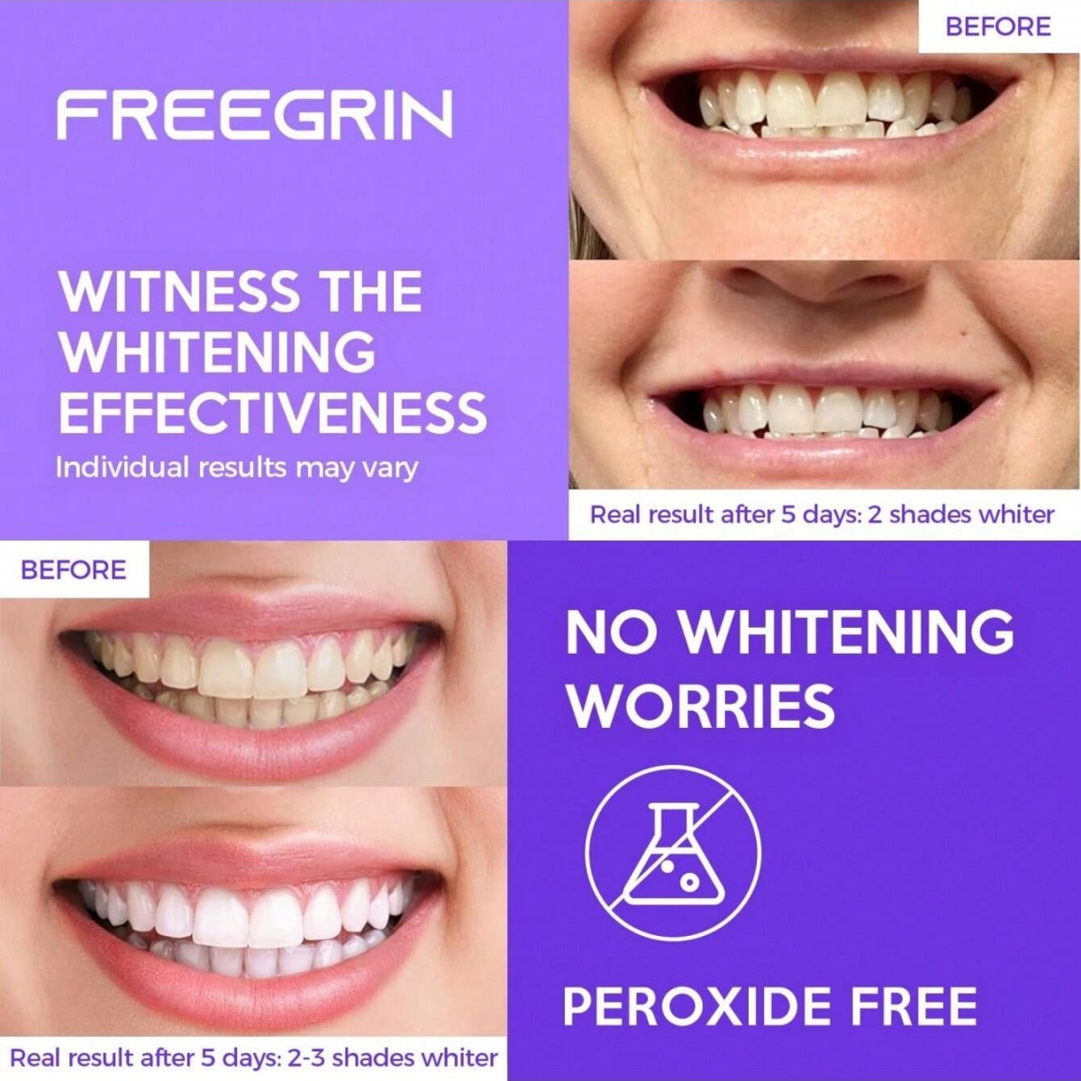 Роскошные отбеливающие наклейк – обзор и цена Teeth Whitening Retainer